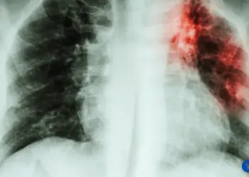 How Much Does a TB Test Cost at CVS?