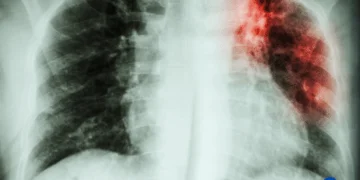 How Much Does a TB Test Cost at CVS?