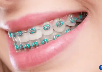 How Much Do Braces Cost?