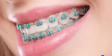How Much Do Braces Cost?