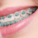 How Much Do Braces Cost?