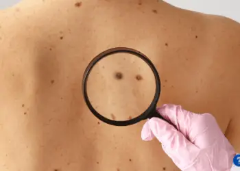 How Much Does Mole Removal Cost?
