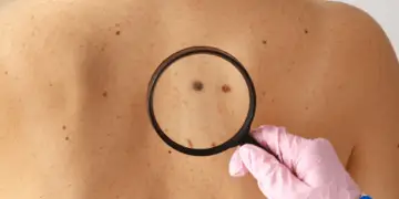 How Much Does Mole Removal Cost?