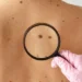 How Much Does Mole Removal Cost?