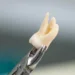 How Much Does Wisdom Teeth Removal Cost?