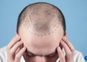 How Much Does a Hair Transplant Cost?