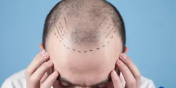 How Much Does a Hair Transplant Cost?