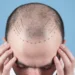 How Much Does a Hair Transplant Cost?
