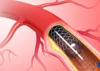 How Much Does a Stent Procedure Cost?