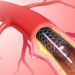 How Much Does a Stent Procedure Cost?