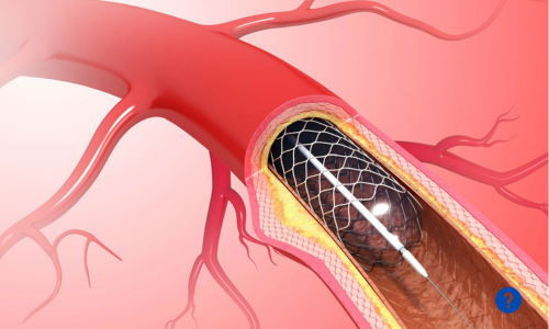 Stent Procedure Cost