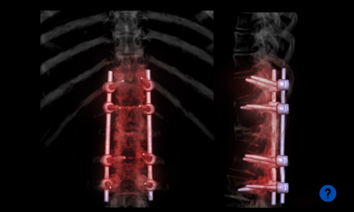 Spinal Fusion Cost