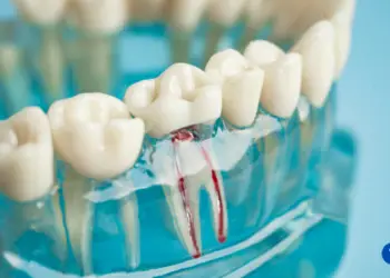How Much Does a Root Canal Cost?