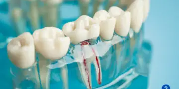How Much Does a Root Canal Cost?