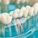 How Much Does a Root Canal Cost?