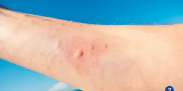 How Much Does It Cost to Treat a Jellyfish Sting?