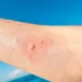 How Much Does It Cost to Treat a Jellyfish Sting?