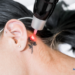 How Much Does Tattoo Removal Cost?