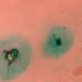 How Much Does a Cholecystectomy Cost?