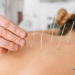 How Much Does an Acupuncturist Cost?